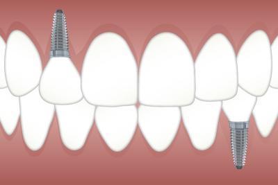 nettoyage implant dentaire paris 20